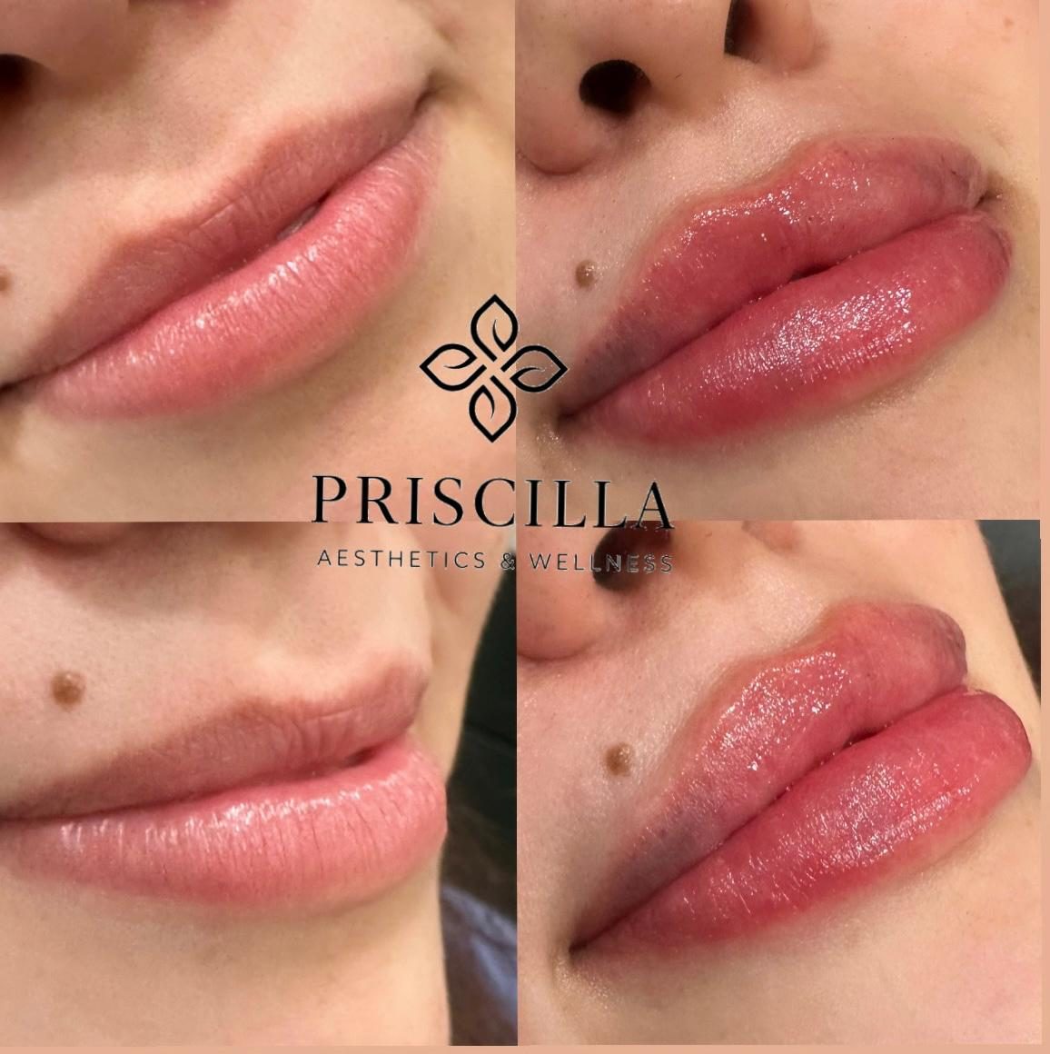 Lip filler before-and-after photos by Priscilla Aesthetics & Wellness